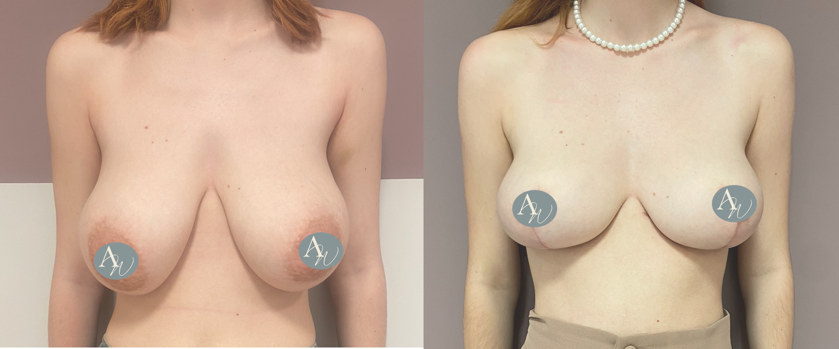 Avant/Après lifting seins et réduction mammaire